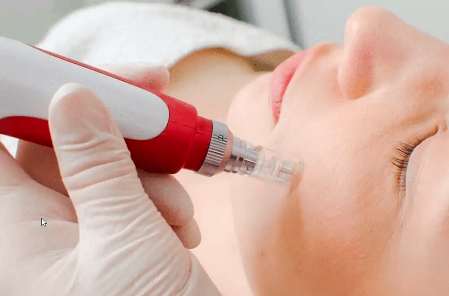 دستگاه میکرونیدلینگ